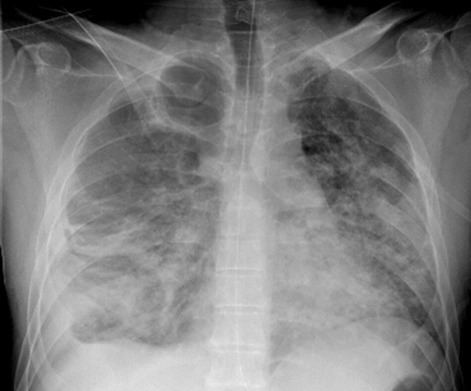SILICOSIS: MALALTIA PROFESSIONAL
